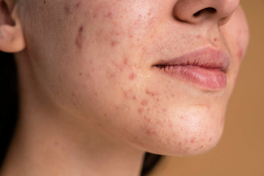 Comment la skincare coréenne traite l'acné efficacement ? - PIBUKARE