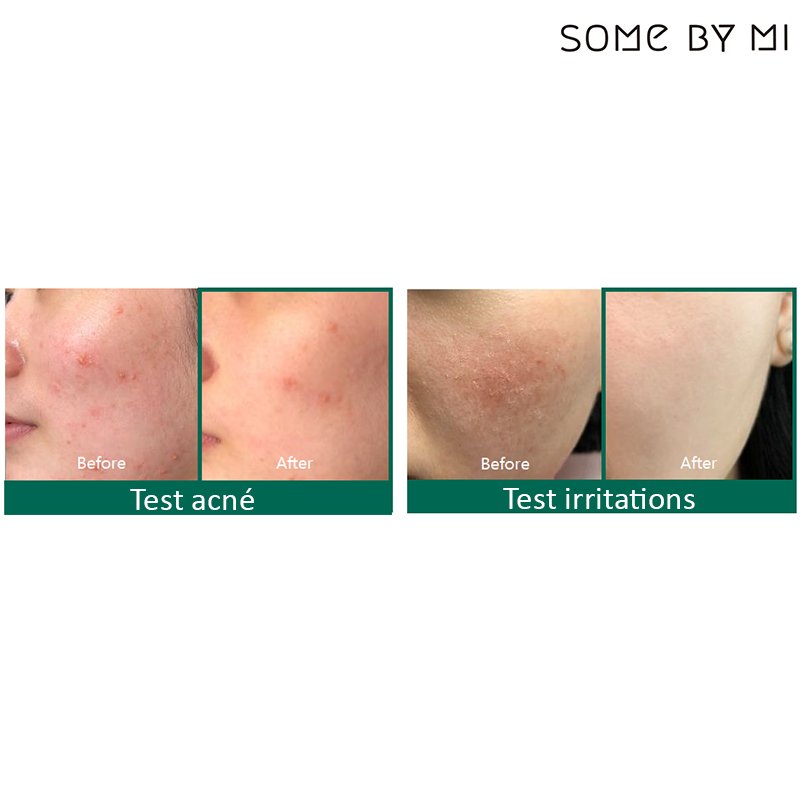 SOME BY MI - AHA-BHA-PHA Miracle Acne Clear Foam - 100 ml - PIBU 피부