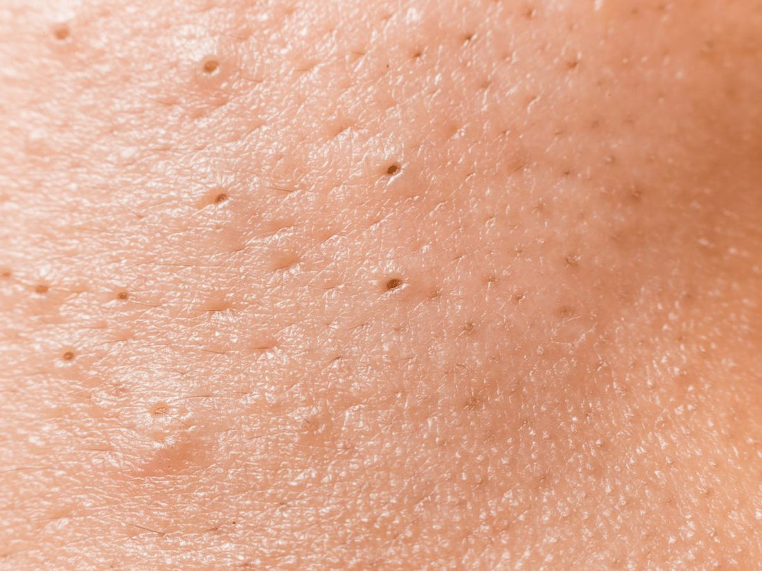 Adieu Points Noirs : Le Guide Expert des Meilleurs Produits à l'Acide Salicylique Coréens