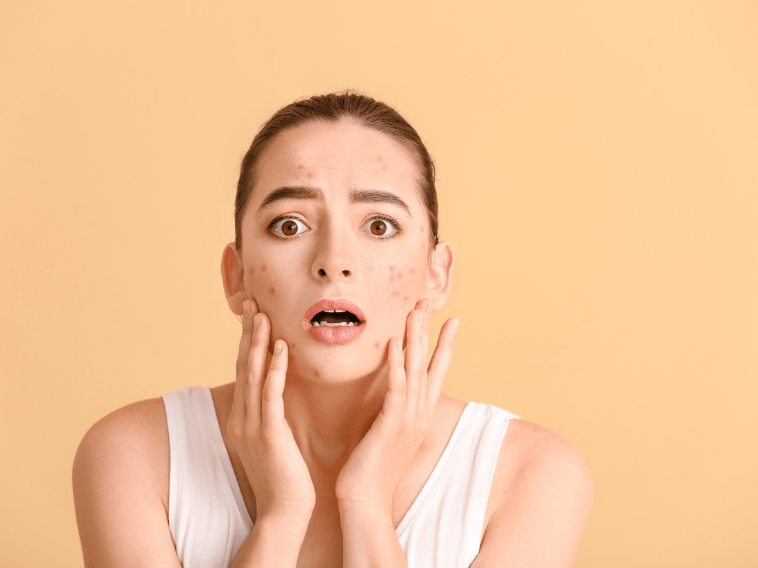 Combattre l'Acné : Les Meilleurs Produits Coréens pour une Peau Claire et Éclatante - PIBUKARE