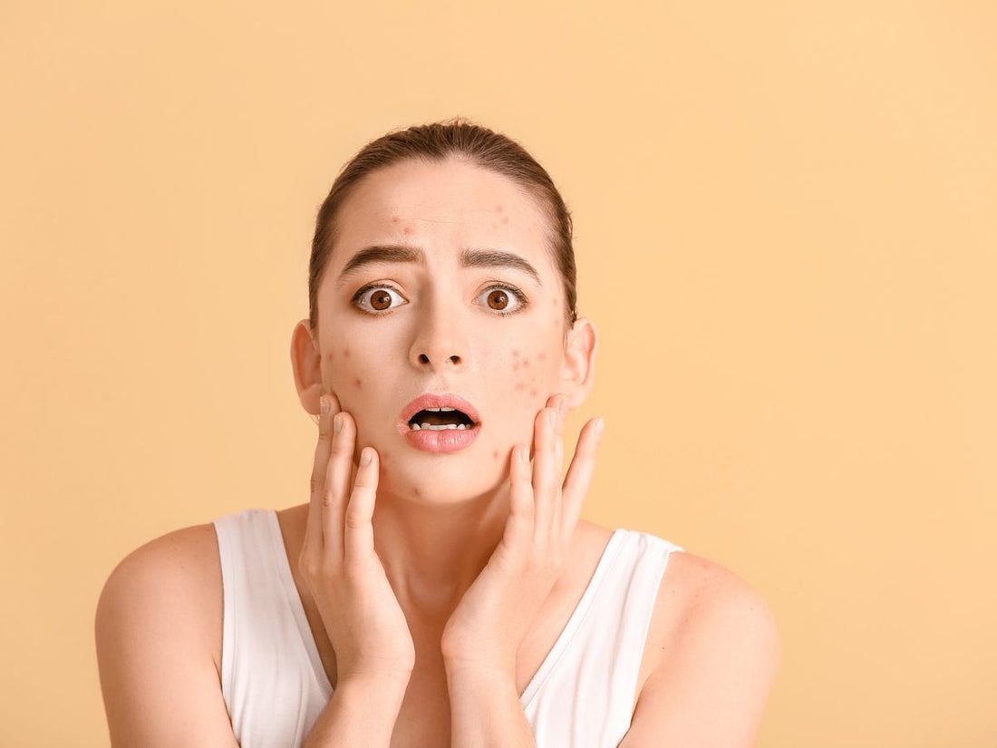 Combattre l'Acné : Les Meilleurs Produits Coréens pour une Peau Claire et Éclatante