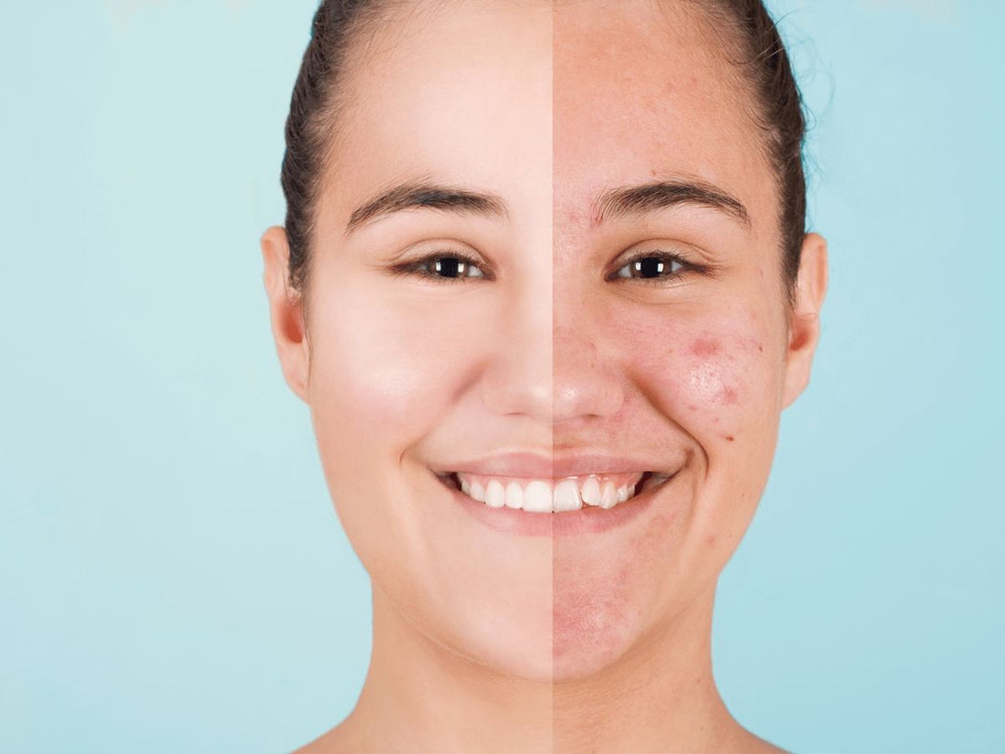 La Vérité Sur la K-Beauty : Pourquoi Elle Combat Si Efficacement l'Acné